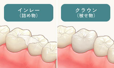 インレー（詰め物）/クラウン（被せ物）