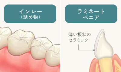 インレー（詰め物）/ラミネートベニア