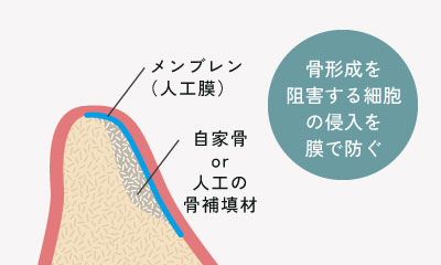 骨形成を阻害する細胞の侵入を膜で防ぐ