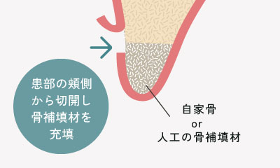 患部の頬側から切開し骨補填材を充填